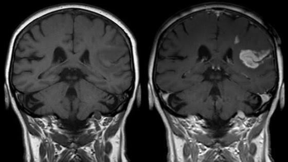 Radiografía dun cerebro despois dun ictus.